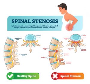comparision between normal spine & stenotic spine]