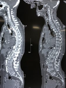 Figure showing osteoporosis fracture showing compression of bones and change in spinal curvature.