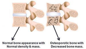 Osteoporosis   figure showing weak spinal bones with loss of bony matrix.
