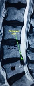 MRI Picture of Slip Disc]