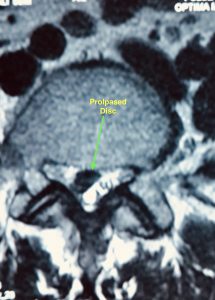 MRI Picture of Slip Disc]