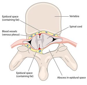 Figure  showing abscess compressing the spinal cord 