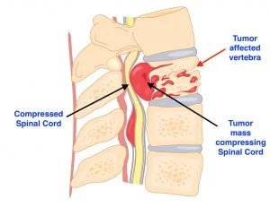 Figure Tumor 1 tumour affecting the vertebral body leading to destruction and compression on the spinal cord