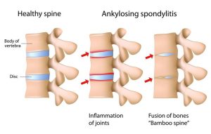 Figure showing how the joint between spinal bones progress from inflammation to complete fusion.