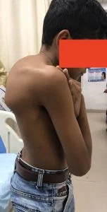 DR Nikhil arbatti Showing development of kyphosis due to abnormal bony development after tuberculosis treatment