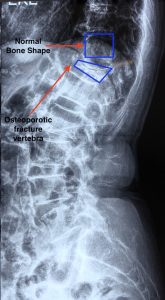 Figure showing osteoporosis fracture showing compression of bones and change in spinal curvature.