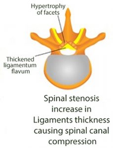 Figure showing normal spinal canal and spinal canal compressed due to artritis and increase thickness]