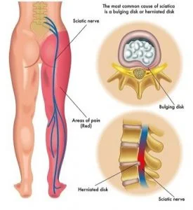 [ Figure showing slipped disc pressing on the nerve]