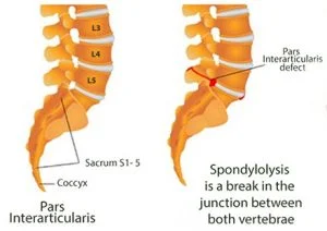 figure of bilateral lumbar lysis.