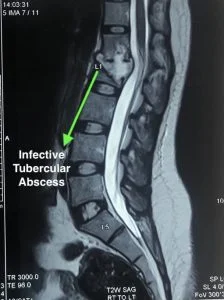 MRI picture showing the abscess with bony destruction