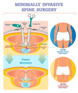 Figure showing benefits of Minimally invasive spine surgery over open Miss Figure showing benefits of Minimally invasive spine surgery over open Miss
