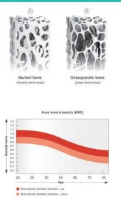 figure showing a dexa scan report which details the changes in bone density of the spine and hip bones. figure showing a dexa scan report which details the changes in bone density of the spine and hip bones.