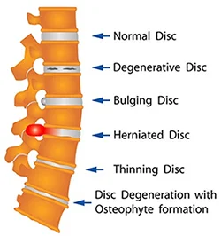 Figure of spine with discs in various stages of degeneration