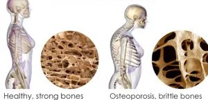 ( figure showing how the bone becomes brittle due to loss of material)