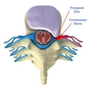  prolapse of intervertebral disc top view