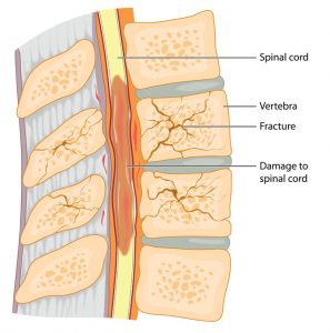  Figures showing bony injury with spinal cord compression and nerve damage