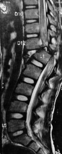  Figures showing bony injury with spinal cord compression and nerve damage