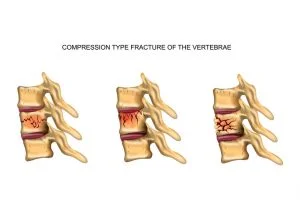 figure showing various types of frat tubes commonly seen