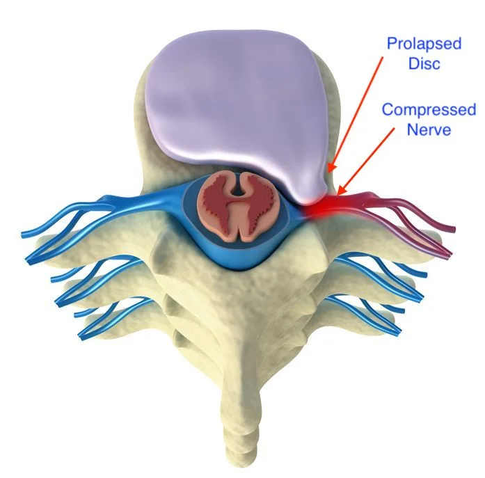 prolapse of intervertebral disc top view